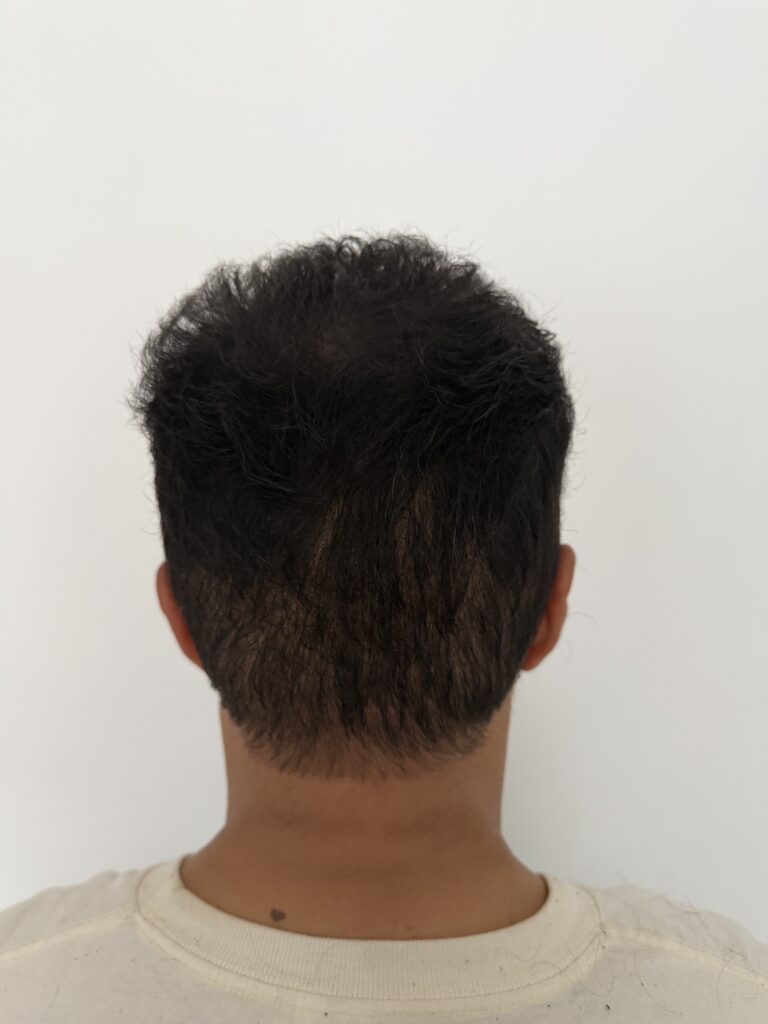 MF HAIR TATTOO _Expert SMP_DENSIT2